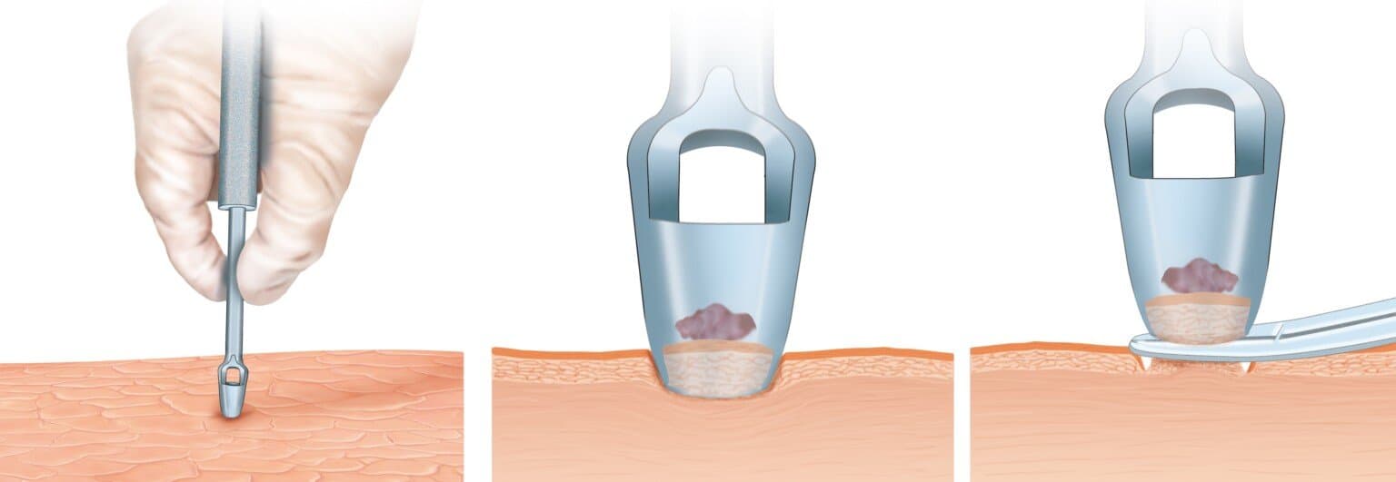 Biopsiyalar