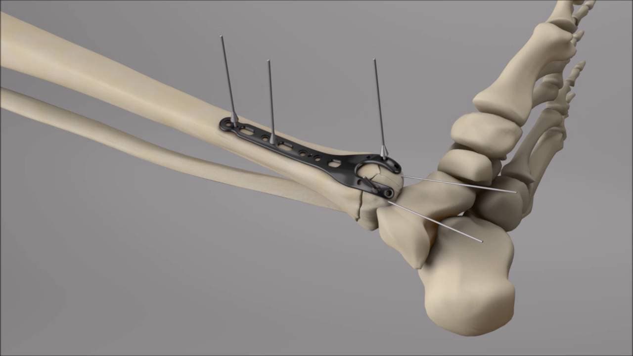 Osteosynthesis operations